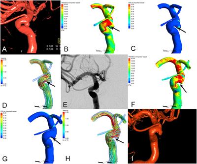 Hemodynamic Characteristics Associated With Paraclinoid Aneurysm Recurrence in Patients After Embolization